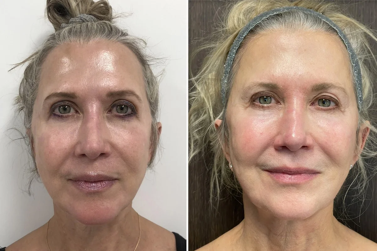 Du glaubst, Brust-OPs brauchen eine Auszeit? Ärzte nutzen jetzt Fett von Toten und das in unter 2 Stunden! - image 1